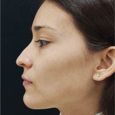antes-despues-clinica-beyou-11