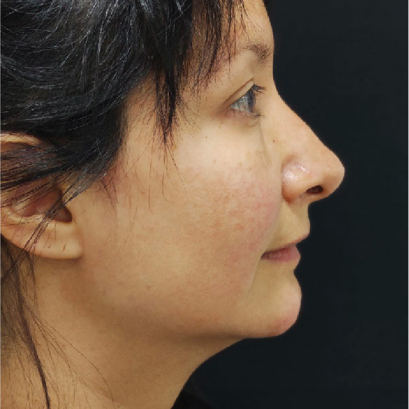 antes y despues-16