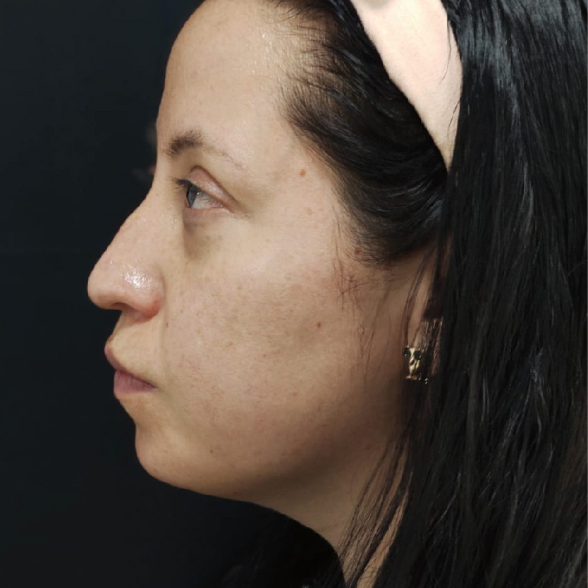 antes y despues-17