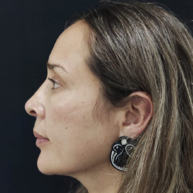 antes-y-despues-full-face-10.jpg