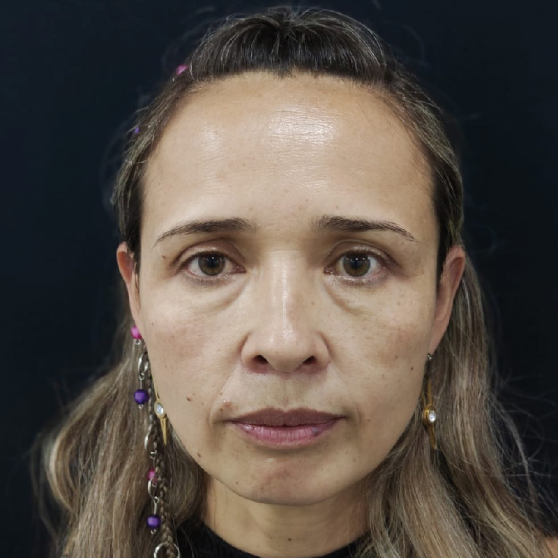 antes-y-despues-full-face-11.jpg