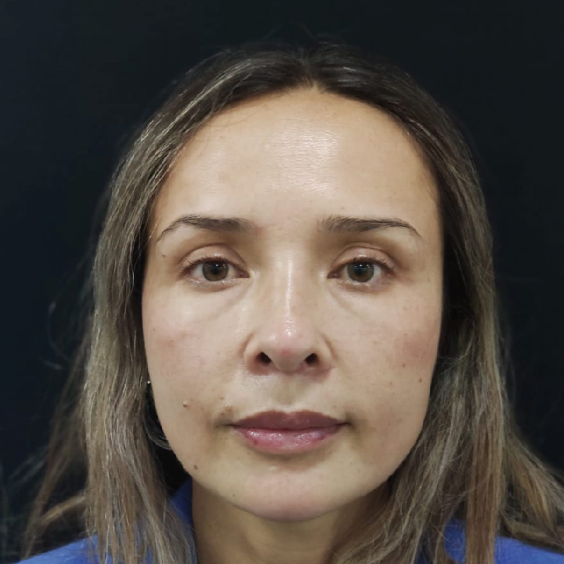 antes-y-despues-full-face-12.jpg